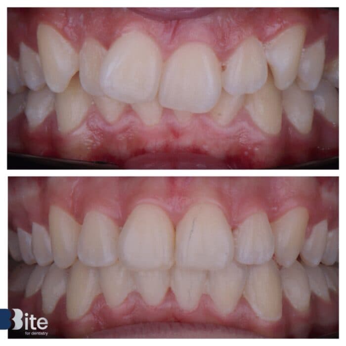 Braces — before and after, a real Bite patient