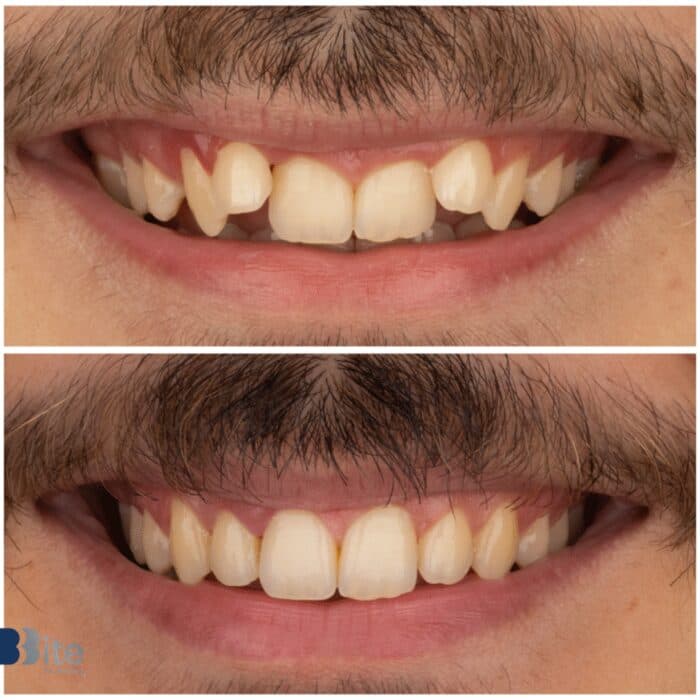 Braces — before and after, a real Bite patient