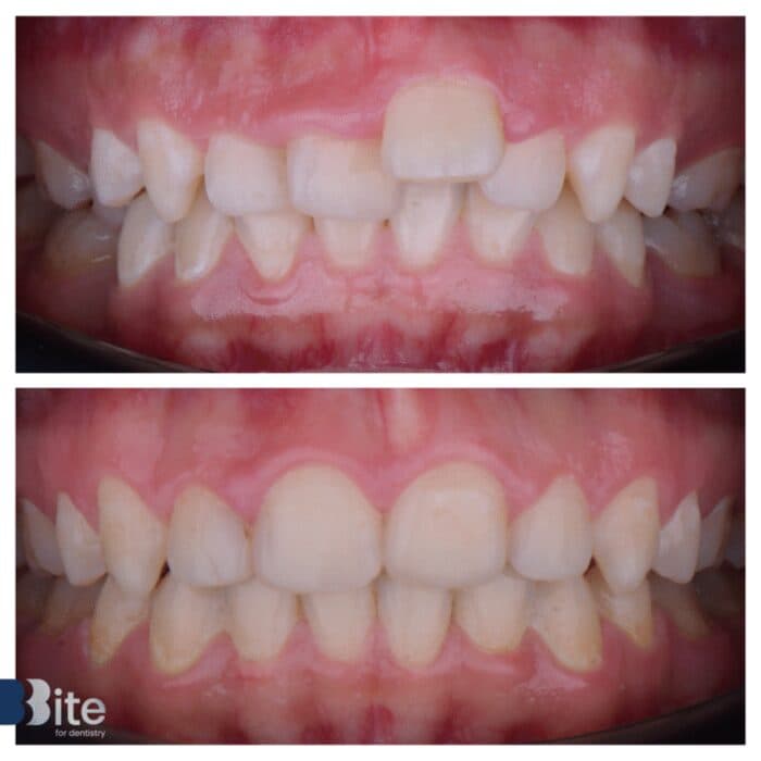 Braces — before and after, a real Bite patient