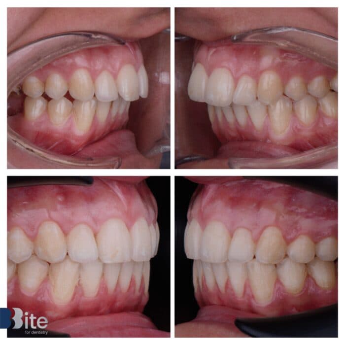 Braces — before and after, a real Bite patient
