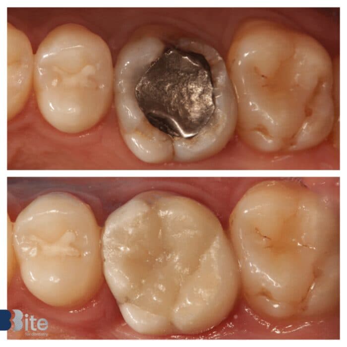 Fillings — before and after, a real Bite patient