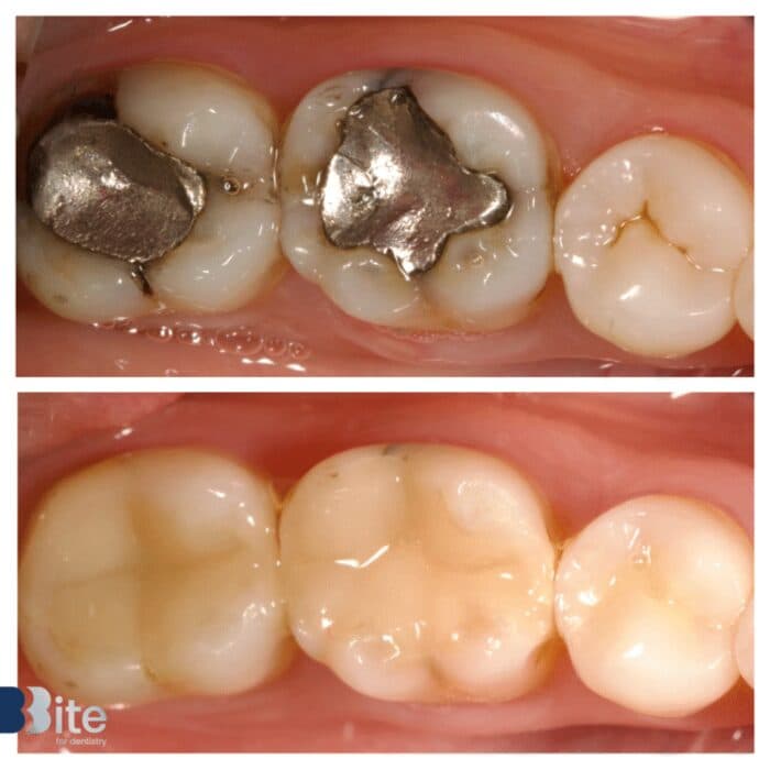 Fillings — before and after, a real Bite patient