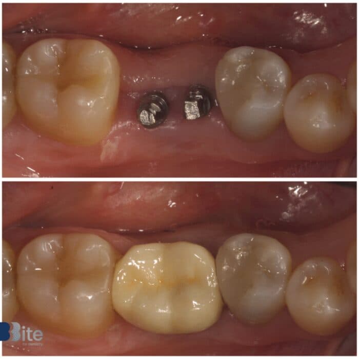Implants — before and after, a real Bite patient