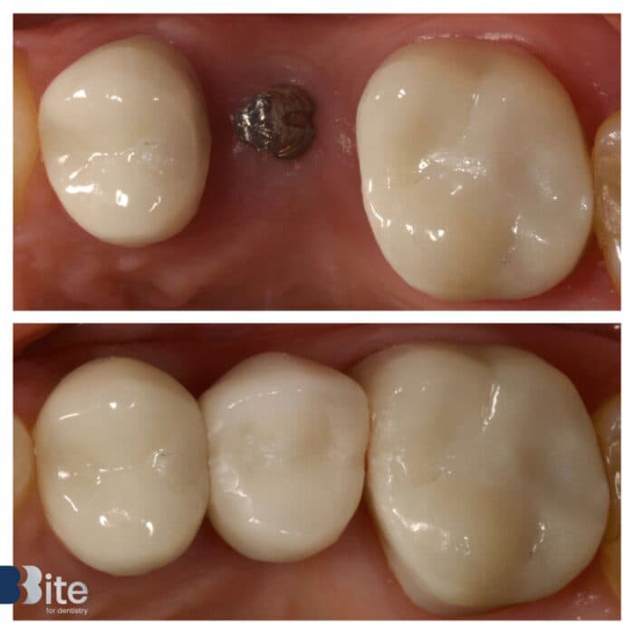 Implants — before and after, a real Bite patient
