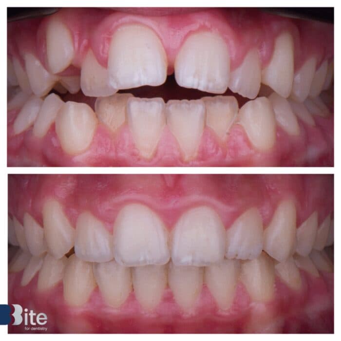 Smile makeover — before and after, a real Bite patient