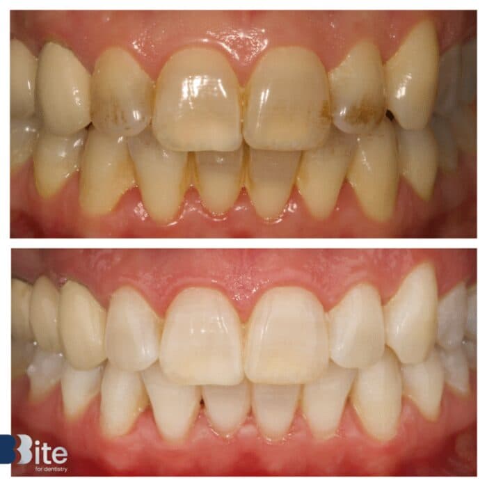 Scaling — before and after, a real Bite patient
