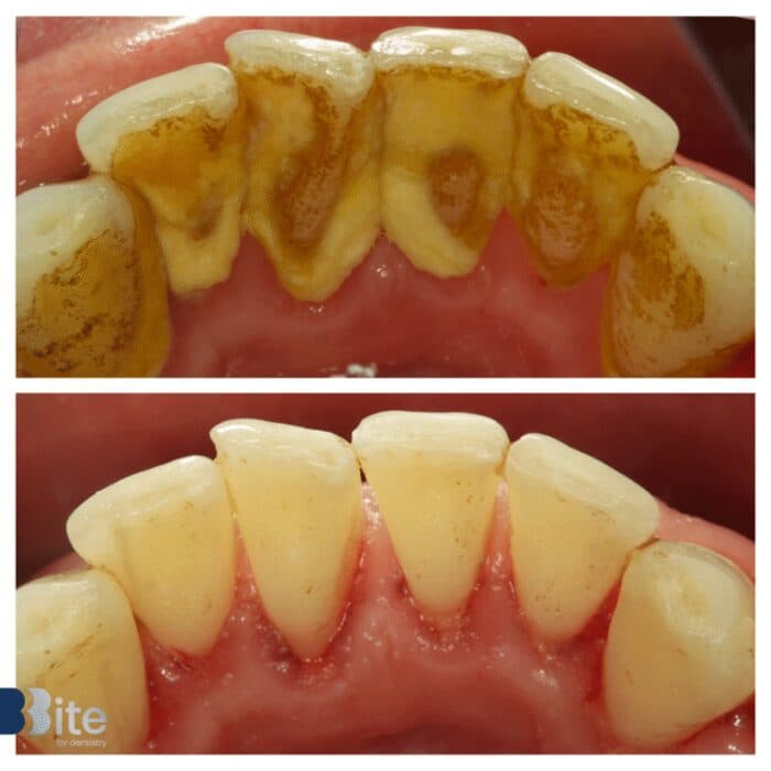 Scaling — before and after, a real Bite patient