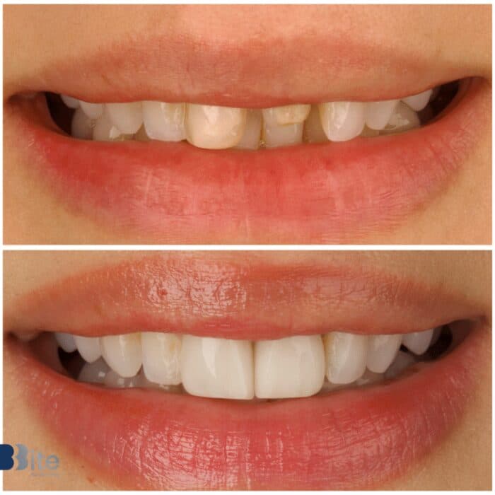 Veneers — before and after, a real Bite patient
