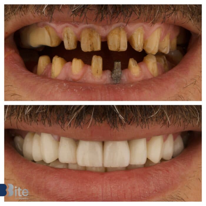 Veneers — before and after, a real Bite patient