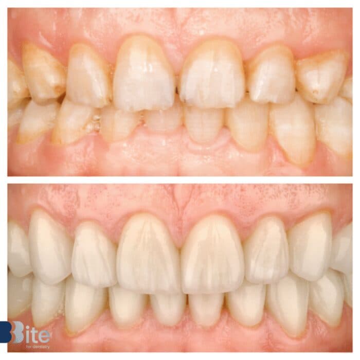 Veneers — before and after, a real Bite patient